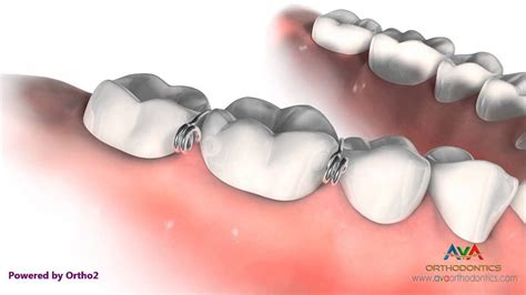 how to fabricate metal tooth separator|spacers for teeth instructions.